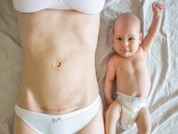 IV. Qual è l’impatto sul microbioma del parto cesareo e di altri interventi alla nascita?